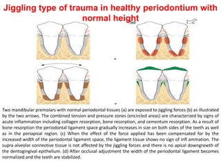 Two mandibular premolars with normal periodontal tissues (a) are exposed to jiggling forces (b) as illustrated
by the two arrows. The combined tension and pressure zones (encircled areas) are characterized by signs of
acute inflammation including collagen resorption, bone resorption, and cementum resorption. As a result of
bone resorption the periodontal ligament space gradually increases in size on both sides of the teeth as well
as in the periapical region. (c) When the effect of the force applied has been compensated for by the
increased width of the periodontal ligament space, the ligament tissue shows no sign of infl ammation. The
supra-alveolar connective tissue is not affected by the jiggling forces and there is no apical downgrowth of
the dentogingival epithelium. (d) After occlusal adjustment the width of the periodontal ligament becomes
normalized and the teeth are stabilized.
Jiggling type of trauma in healthy periodontium with
normal height
 