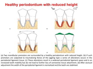 Healthy periodontium with reduced height
(a) Two mandibular premolars are surrounded by a healthy periodontium with reduced height. (b) If such
premolars are subjected to traumatizing forces of the jiggling type a series of alterations occurs in the
periodontal ligament tissue. (c) These alterations result in a widened periodontal ligament space and in an
increased tooth mobility but do not lead to further loss of connective tissue attachment. (d) After occlusal
adjustment the width of the periodontal ligament is normalized and the teeth are stabilized.
 