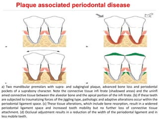 Plaque associated periodontal disease
a) Two mandibular premolars with supra- and subgingival plaque, advanced bone loss and periodontal
pockets of a suprabony character. Note the connective tissue infi ltrate (shadowed areas) and the uninfl
amed connective tissue between the alveolar bone and the apical portion of the infi ltrate. (b) If these teeth
are subjected to traumatizing forces of the jiggling type, pathologic and adaptive alterations occur within the
periodontal ligament space. (c) These tissue alterations, which include bone resorption, result in a widened
periodontal ligament space and increased tooth mobility but no further loss of connective tissue
attachment. (d) Occlusal adjustment results in a reduction of the width of the periodontal ligament and in
less mobile teeth.
 