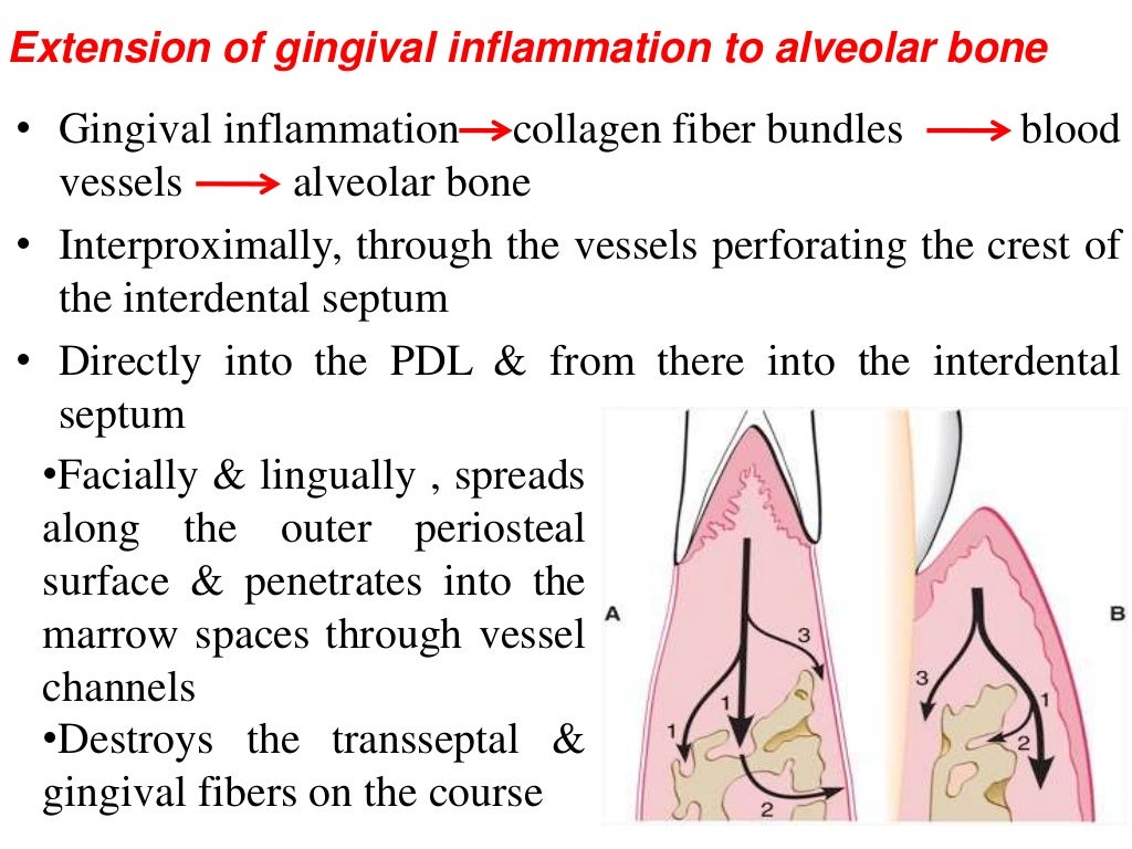 Trauma from occlusion