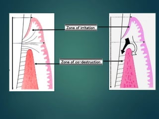 Zone of irritation
Zone of co-destruction
 