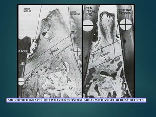 MICROPHOTOGRAPHS OF TWO INTERPROXIMAL AREAS WITH ANGULAR BONY DEFECTS
 