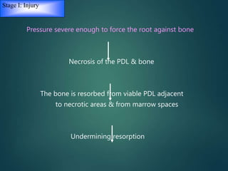Stage I: Injury
Pressure severe enough to force the root against bone
Necrosis of the PDL & bone
The bone is resorbed from viable PDL adjacent
to necrotic areas & from marrow spaces
Undermining resorption
 