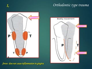 Orthodontic type trauma
forces does not cause inflammation in gingiva
1,
 