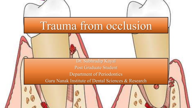 Trauma from occlusion in Periodontics.pptx | Dental Health | Diseases ...