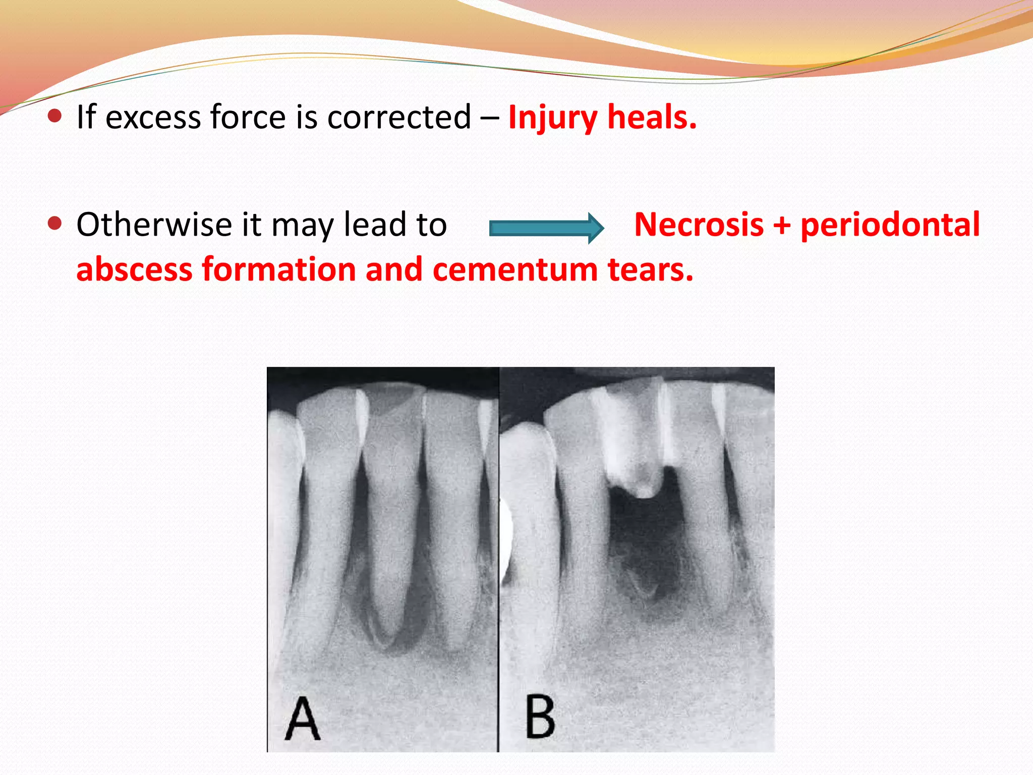  If excess force is corrected – Injury heals.
 Otherwise it may lead to Necrosis + periodontal
abscess formation and cementum tears.
 