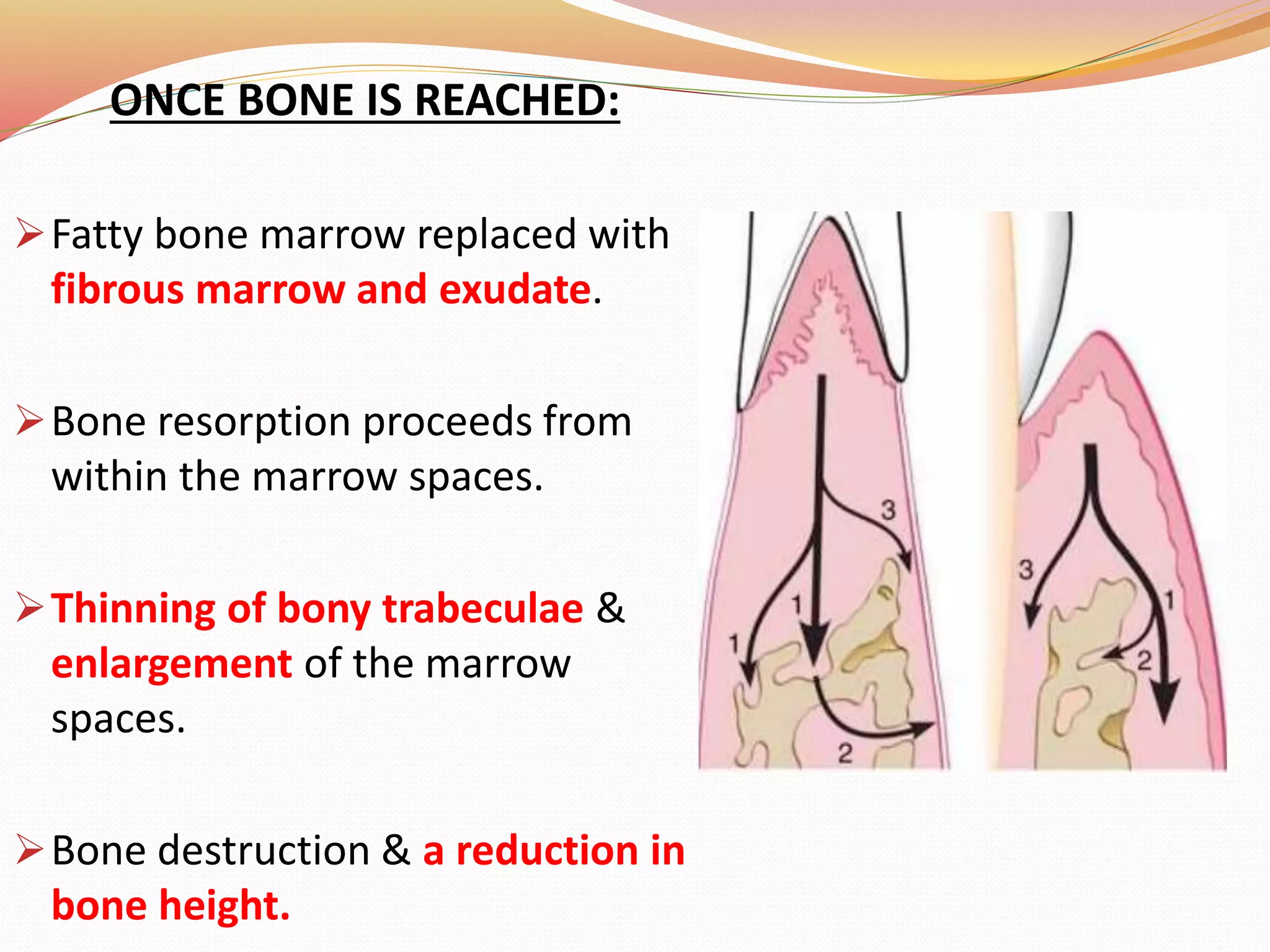 ONCE BONE IS REACHED:
Fatty bone marrow replaced with
fibrous marrow and exudate.
Bone resorption proceeds from
within the marrow spaces.
Thinning of bony trabeculae &
enlargement of the marrow
spaces.
Bone destruction & a reduction in
bone height.
 