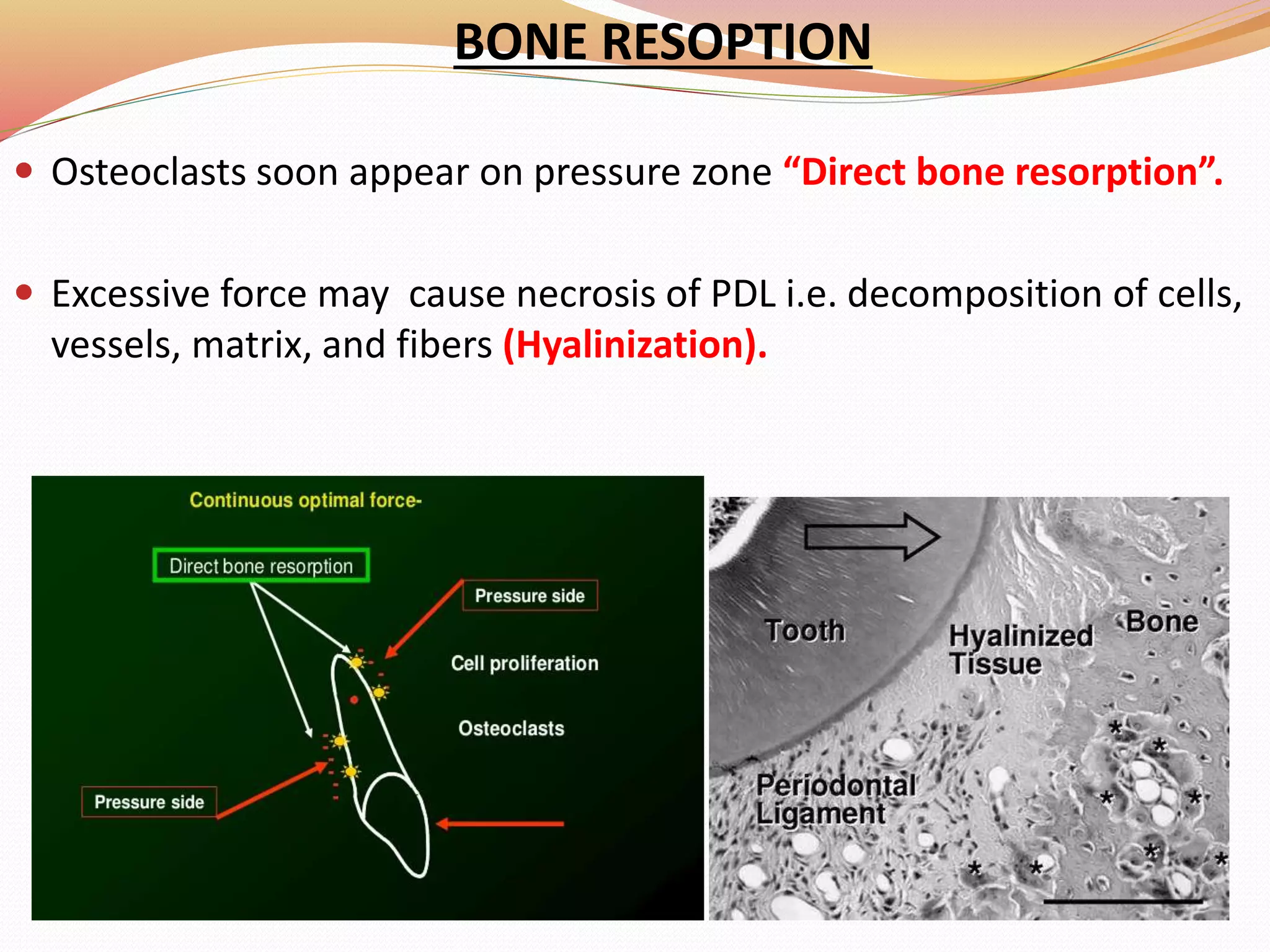 BONE RESOPTION
 Osteoclasts soon appear on pressure zone “Direct bone resorption”.
 Excessive force may cause necrosis of PDL i.e. decomposition of cells,
vessels, matrix, and fibers (Hyalinization).
 