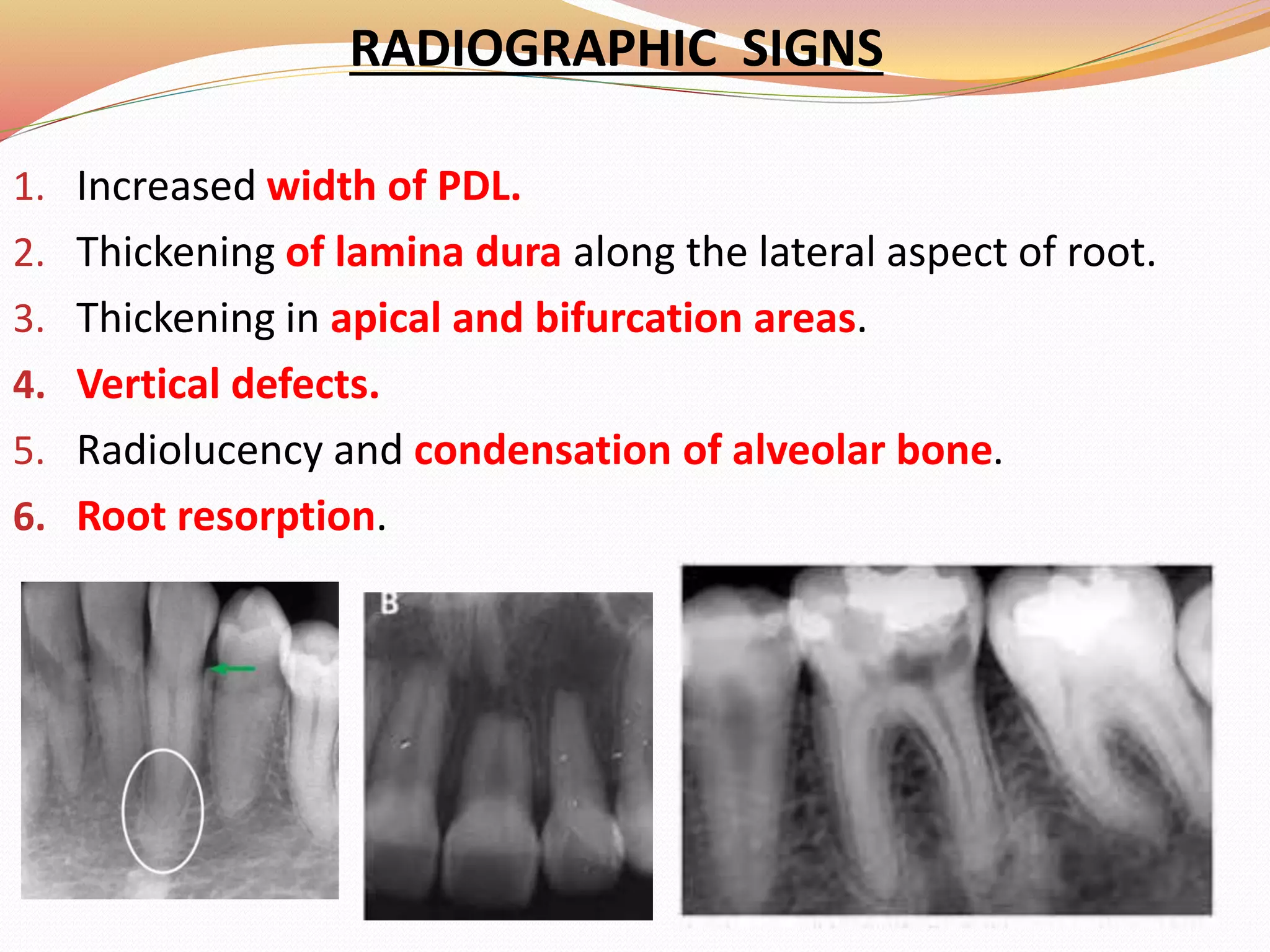 RADIOGRAPHIC SIGNS
1. Increased width of PDL.
2. Thickening of lamina dura along the lateral aspect of root.
3. Thickening in apical and bifurcation areas.
4. Vertical defects.
5. Radiolucency and condensation of alveolar bone.
6. Root resorption.
 