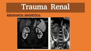 Trauma Renal
RESONANCIA MAGNETICA:
 