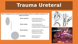 Trauma Ureteral
 