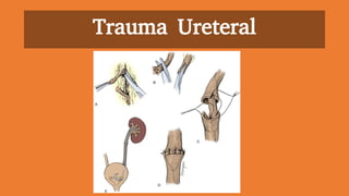 Trauma Ureteral
 