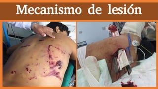 Mecanismo de lesión
 