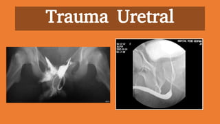 Trauma Uretral
 