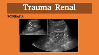 Trauma Renal
ECOGRAFIA:
 