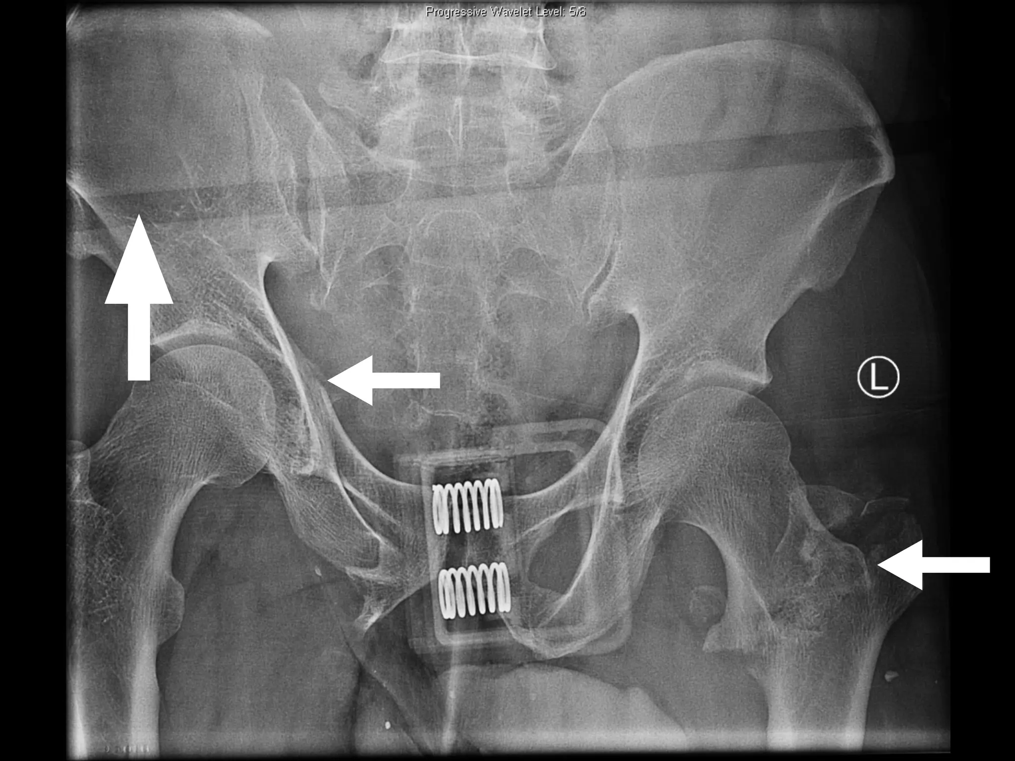 Gs Grand Rounds Trauma Grand Round - Pelvis | PDF