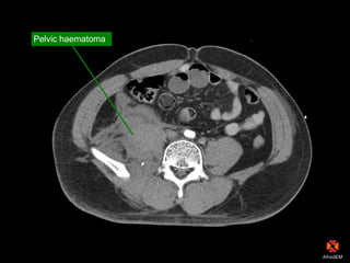 Pelvic haematoma
 