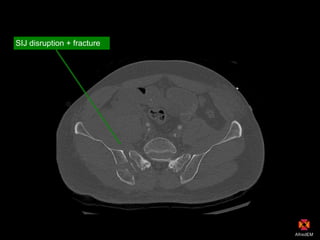 SIJ disruption + fracture
 