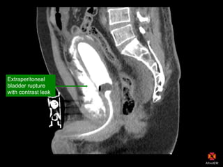 CT scan
Extraperitoneal
bladder rupture
with contrast leak
 