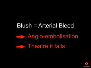 Blush = Arterial Bleed
Angio-embolisation
Theatre if fails
 