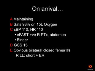 On arrival…
A Maintaining
B Sats 98% on 15L Oxygen
C sBP 110, HR 110
• eFAST +ve R PTx, abdomen
• Binder
D GCS 15
E Obvious bilateral closed femur #s
R LL: short + ER
 