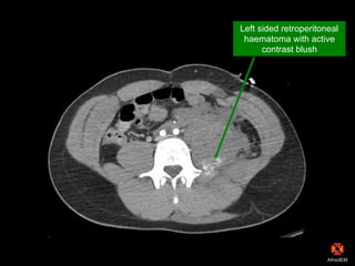 Left sided retroperitoneal
haematoma with active
contrast blush
 
