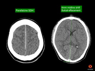 Parafalcine SDH
4mm midline shift
Sulcal effacement
 
