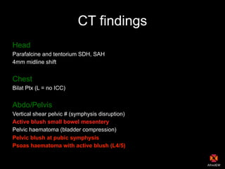 CT findings
Head
Parafalcine and tentorium SDH, SAH
4mm midline shift
Chest
Bilat Ptx (L = no ICC)
Abdo/Pelvis
Vertical shear pelvic # (symphysis disruption)
Active blush small bowel mesentery
Pelvic haematoma (bladder compression)
Pelvic blush at pubic symphysis
Psoas haematoma with active blush (L4/5)
 