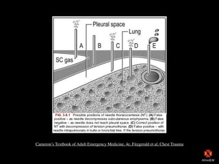 Cameron’s Textbook of Adult Emergency Medicine, 4e, Fitzgerald et al, Chest Trauma
 