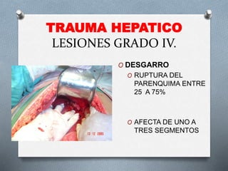 TRAUMA HEPATICO
LESIONES GRADO IV.
O DESGARRO
O RUPTURA DEL
PARENQUIMA ENTRE
25 A 75%
O AFECTA DE UNO A
TRES SEGMENTOS
 