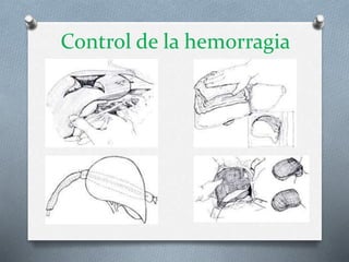 Control de la hemorragia
 