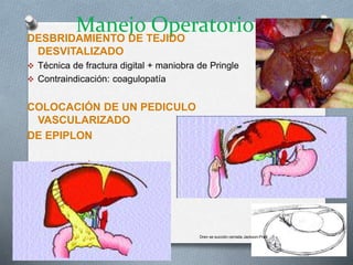 Manejo OperatorioDESBRIDAMIENTO DE TEJIDO
DESVITALIZADO
 Técnica de fractura digital + maniobra de Pringle
 Contraindicación: coagulopatía
COLOCACIÓN DE UN PEDICULO
VASCULARIZADO
DE EPIPLON
COLOCACIÓN DE DRENES
Dren se succión cerrada Jackson-Pratt
 