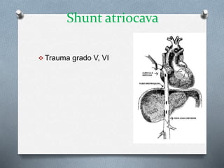 Shunt atriocava
 Trauma grado V, VI
 