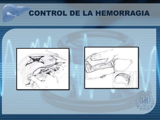 CONTROL DE LA HEMORRAGIA
 
