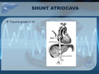 SHUNT ATRIOCAVA
 Trauma grado V, VI
 