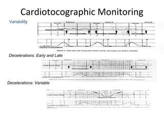 Cardiotocographic Monitoring
Variabilityi
Decelerations: Early and Late
Decelerations: Variable
 