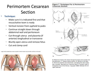 Perimortem Cesarean
Section
• Technique:
– Make sure it is indicated first and that
resuscitative team is ready
– Vertical incision from xyphoid to pubis
– Continue straight down through
abdominal wall and peritoneum
– Cut through uterus and placenta (if
anterior) longitudinal or transverse
– Bluntly open uterus and remove fetus
– Cut and clamp cord
 