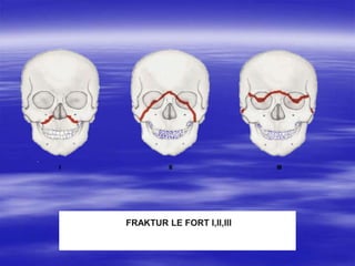 FRAKTUR LE FORT I,II,III
FRAKTUR
 