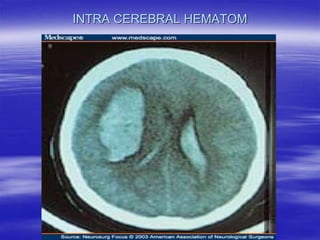 INTRA CEREBRAL HEMATOM
 