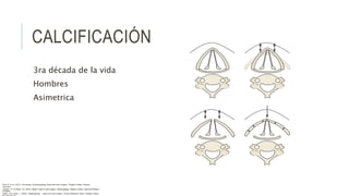 CALCIFICACIÓN
3ra década de la vida
Hombres
Asimetrica
Flint, P. et al. (2021). Cummings. Otolaryngology–head and neck surgery. Estados Unidos: Elsevier
Saunders.
Johnson, JT- & Rosen, CA. (2014). Bailey’s head & neck surgery. Otolaryngology. Estados Unidos: Lippincott Williams
& Wilkins.
Pasha, R & Golub, J. (2018). Otolaryngology – Head and neck surgery. Clinical Reference Guide. Estados Unidos:
 