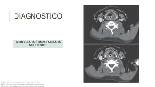 DIAGNOSTICO
TOMOGRAFIA COMPUTARIZADA
MULTICORTE
Flint, P. et al. (2021). Cummings. Otolaryngology–head and neck surgery. Estados Unidos: Elsevier
Saunders.
Johnson, JT- & Rosen, CA. (2014). Bailey’s head & neck surgery. Otolaryngology. Estados Unidos: Lippincott Williams
& Wilkins.
Pasha, R & Golub, J. (2018). Otolaryngology – Head and neck surgery. Clinical Reference Guide. Estados Unidos:
 