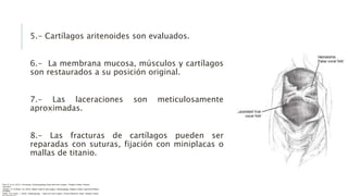 5.- Cartílagos aritenoides son evaluados.
6.- La membrana mucosa, músculos y cartílagos
son restaurados a su posición original.
7.- Las laceraciones son meticulosamente
aproximadas.
8.- Las fracturas de cartílagos pueden ser
reparadas con suturas, fijación con miniplacas o
mallas de titanio.
Flint, P. et al. (2021). Cummings. Otolaryngology–head and neck surgery. Estados Unidos: Elsevier
Saunders.
Johnson, JT- & Rosen, CA. (2014). Bailey’s head & neck surgery. Otolaryngology. Estados Unidos: Lippincott Williams
& Wilkins.
Pasha, R & Golub, J. (2018). Otolaryngology – Head and neck surgery. Clinical Reference Guide. Estados Unidos:
 