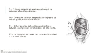 9.- El borde anterior de cada cuerda vocal es
suturada al cartílago tiroides
10.- Comisura anterior desprovista de epitelio se
coloca quilla preformad o silicón.
11.- Si hay pérdida del cartílago cricoides se
suturan los músculos infrahioideos en el defecto.
12.- La tirotomía se cierra con suturas absorbibles
o con mini placas.
Flint, P. et al. (2021). Cummings. Otolaryngology–head and neck surgery. Estados Unidos: Elsevier
Saunders.
Johnson, JT- & Rosen, CA. (2014). Bailey’s head & neck surgery. Otolaryngology. Estados Unidos: Lippincott Williams
& Wilkins.
Pasha, R & Golub, J. (2018). Otolaryngology – Head and neck surgery. Clinical Reference Guide. Estados Unidos:
 