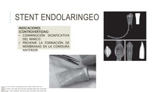 STENT ENDOLARINGEO
INDICACIONES
(CONTROVERTIDAS)
• CONMINUCIÓN SIGNIFICATIVA
DEL MARCO
• PREVENIR LA FORMACIÓN DE
MEMBRANAS EN LA COMISURA
ANTERIOR
Flint, P. et al. (2021). Cummings. Otolaryngology–head and neck surgery. Estados Unidos: Elsevier
Saunders.
Johnson, JT- & Rosen, CA. (2014). Bailey’s head & neck surgery. Otolaryngology. Estados Unidos: Lippincott Williams
& Wilkins.
Pasha, R & Golub, J. (2018). Otolaryngology – Head and neck surgery. Clinical Reference Guide. Estados Unidos:
 