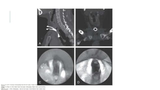Flint, P. et al. (2021). Cummings. Otolaryngology–head and neck surgery. Estados Unidos: Elsevier
Saunders.
Johnson, JT- & Rosen, CA. (2014). Bailey’s head & neck surgery. Otolaryngology. Estados Unidos: Lippincott Williams
& Wilkins.
Pasha, R & Golub, J. (2018). Otolaryngology – Head and neck surgery. Clinical Reference Guide. Estados Unidos:
 