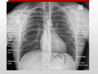 Hemothorax and
Pneumothorax - most
common injuries from both
blunt and penetrating
thoracic trauma
 
