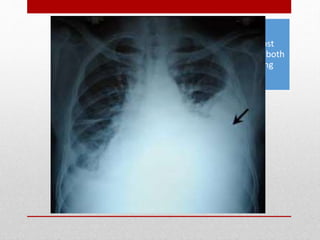 Hemothorax and
Pneumothorax - most
common injuries from both
blunt and penetrating
thoracic trauma
 