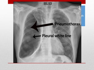 Hemothorax and
Pneumothorax - most
common injuries from both
blunt and penetrating
thoracic trauma
 