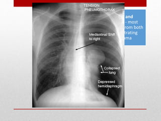 Hemothorax and
Pneumothorax - most
common injuries from both
blunt and penetrating
thoracic trauma
 