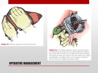 OPERATIVE MANAGEMENT
• Bile leaks
• Abscess
• Hemorrhage
• Devascularization
 